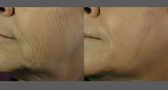 icon-2940-1540-combo-alibhai-wrinkle-prepost1tx-1-crop-u873